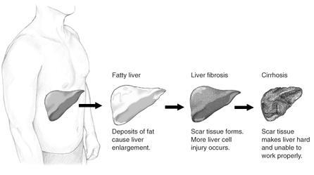 脂肪肝による肝臓の変化